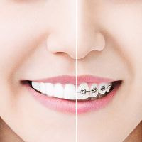 インビザライン 比較写真